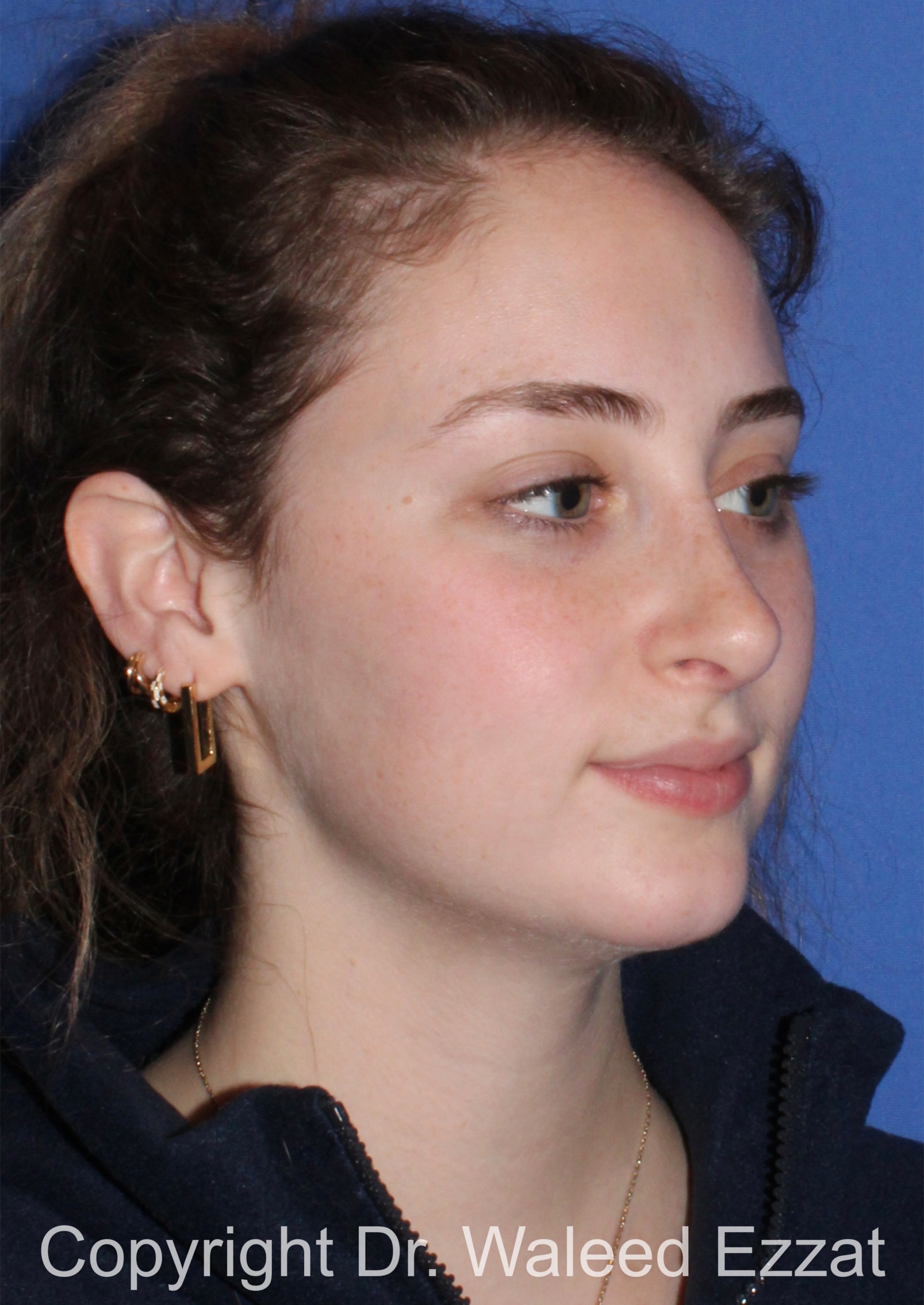 Caucasian/European Rhinoplasty Patient Photo - Case 350 - after view-1