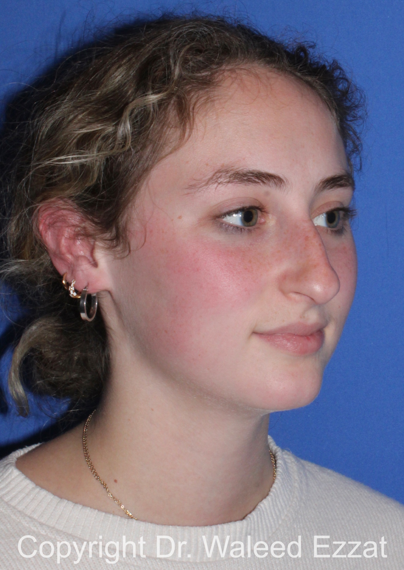 Caucasian/European Rhinoplasty Patient Photo - Case 350 - before view-1