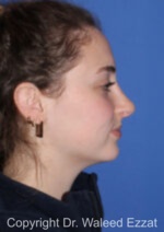 Caucasian/European Rhinoplasty - Case 350 - After
