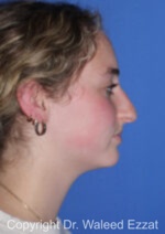 Caucasian/European Rhinoplasty - Case 350 - Before