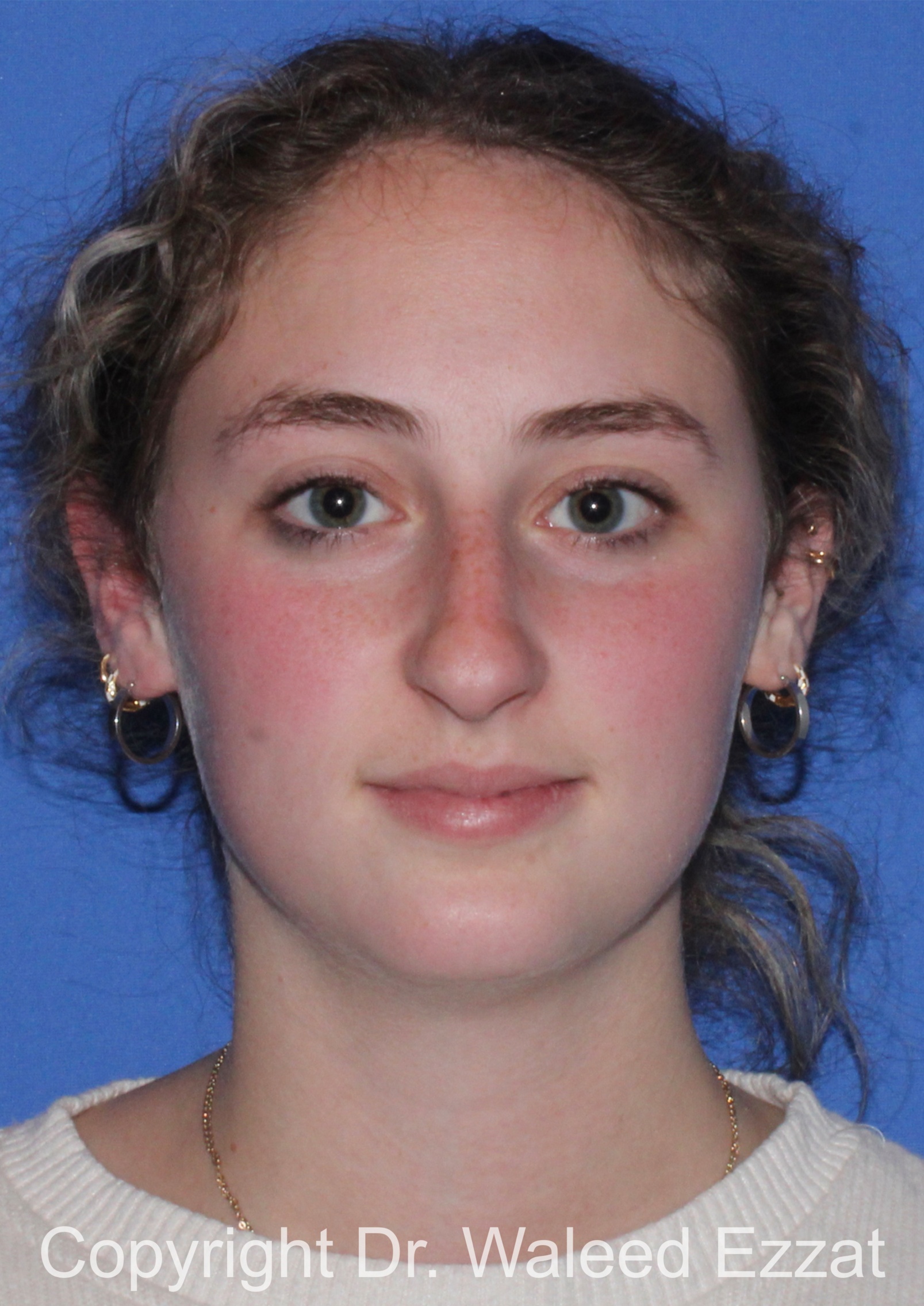 Caucasian/European Rhinoplasty Patient Photo - Case 350 - before view-2