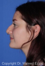 Caucasian/European Rhinoplasty - Case 351 - Before