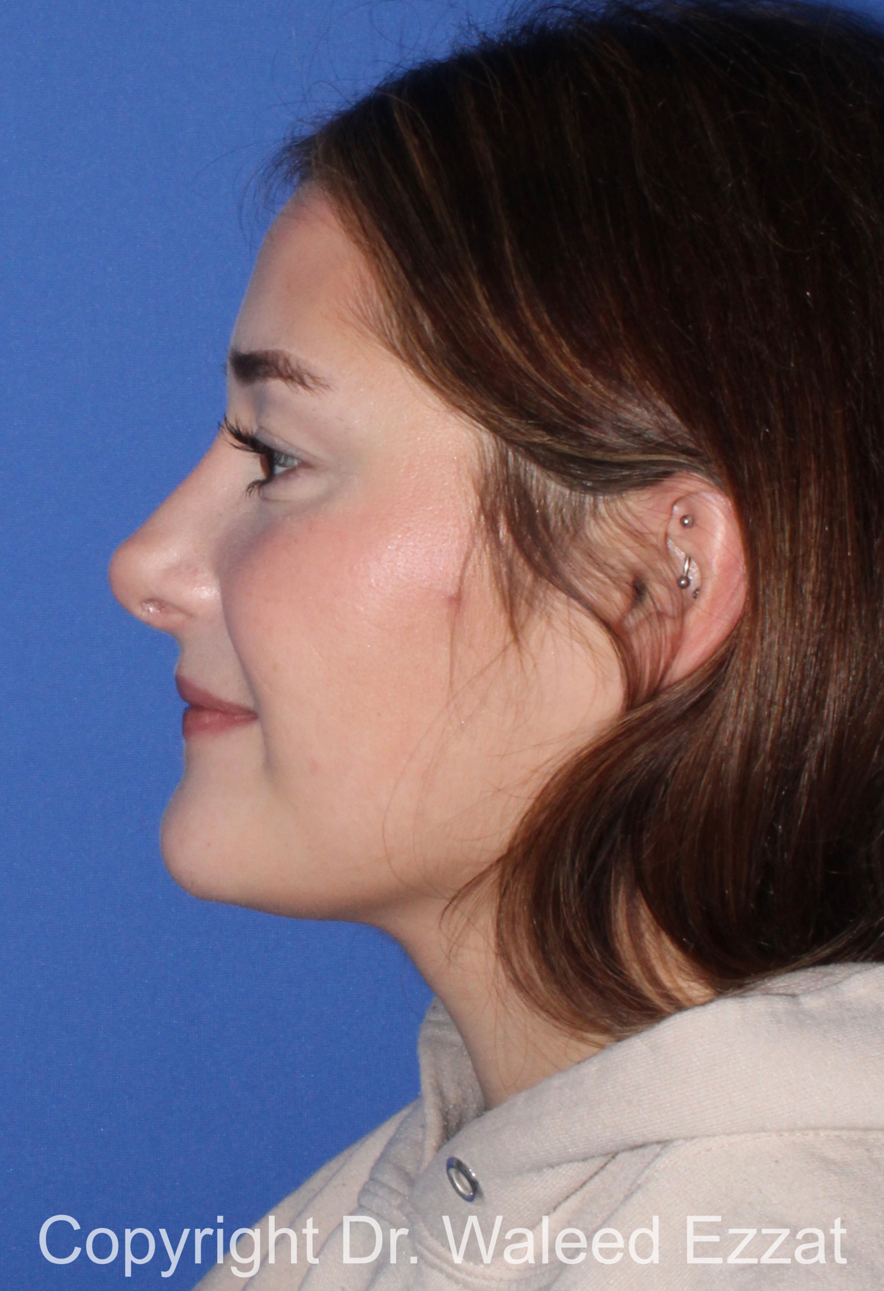 Caucasian/European Rhinoplasty Patient Photo - Case 351 - after view