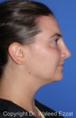 Caucasian/European Rhinoplasty - Case 352 - After