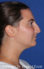 Caucasian/European Rhinoplasty - Case 352 - Before