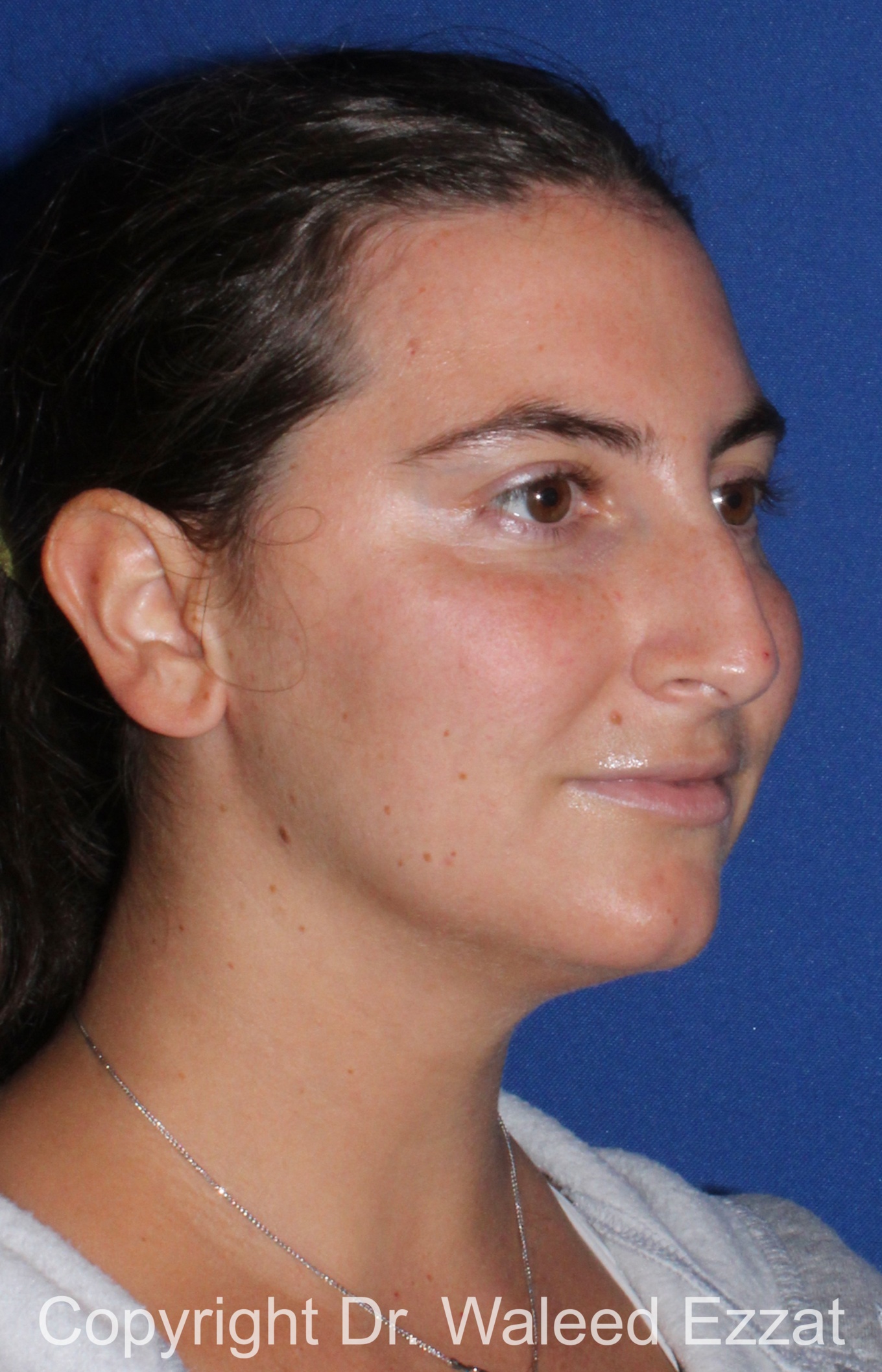 Caucasian/European Rhinoplasty Patient Photo - Case 352 - before view-1