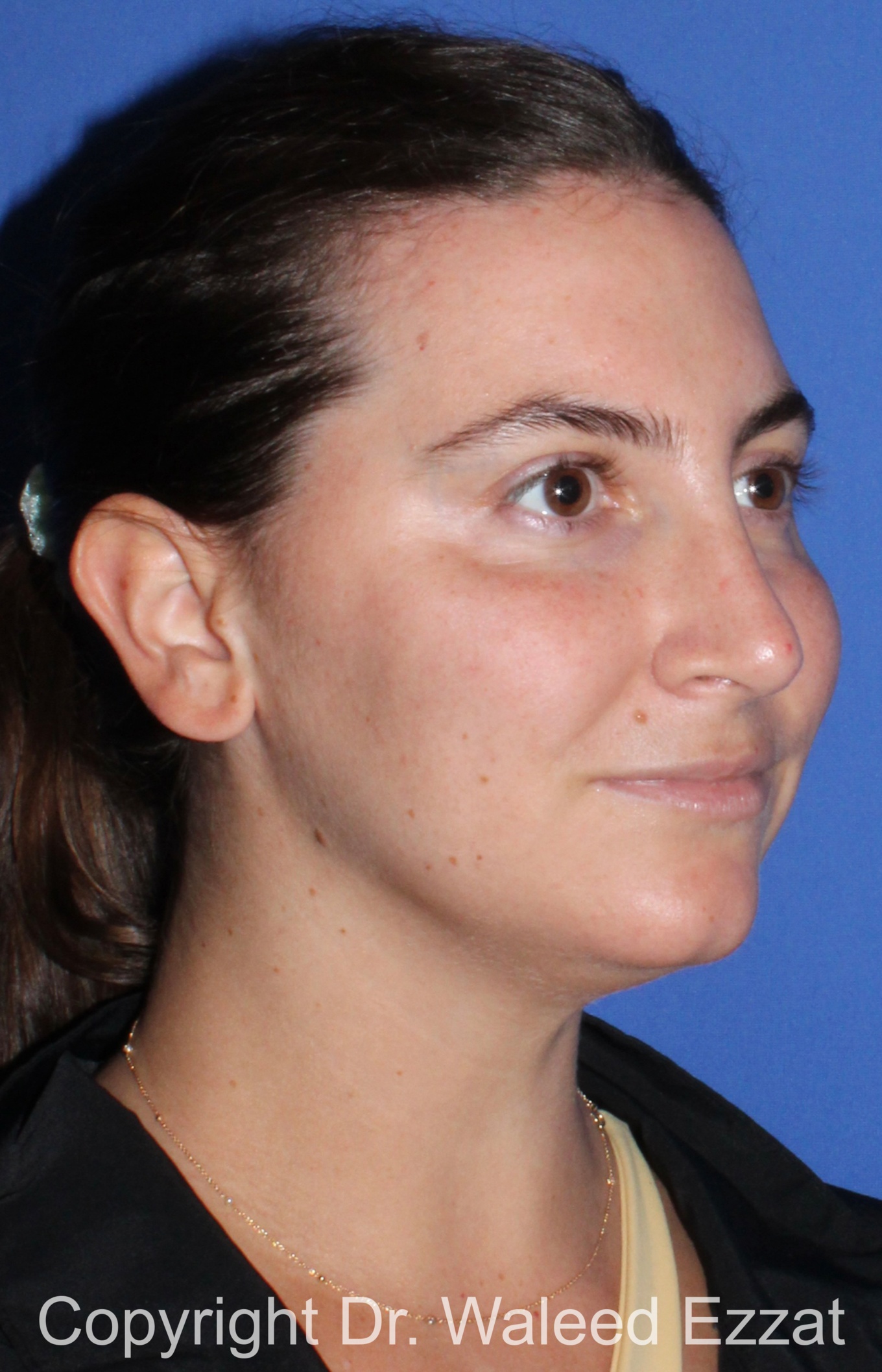 Caucasian/European Rhinoplasty Patient Photo - Case 352 - after view-1