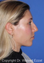 Caucasian/European Rhinoplasty - Case 353 - Before