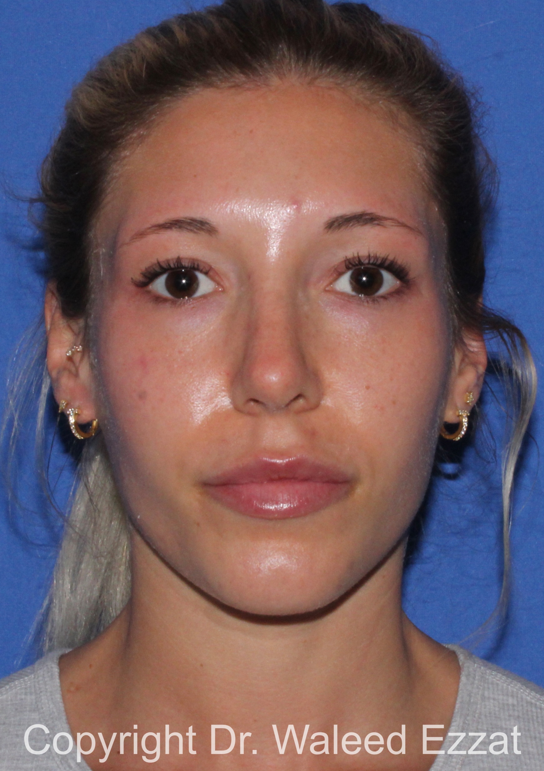 Caucasian/European Rhinoplasty Patient Photo - Case 353 - after view-2