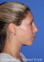 Caucasian/European Rhinoplasty - Case 353 - After