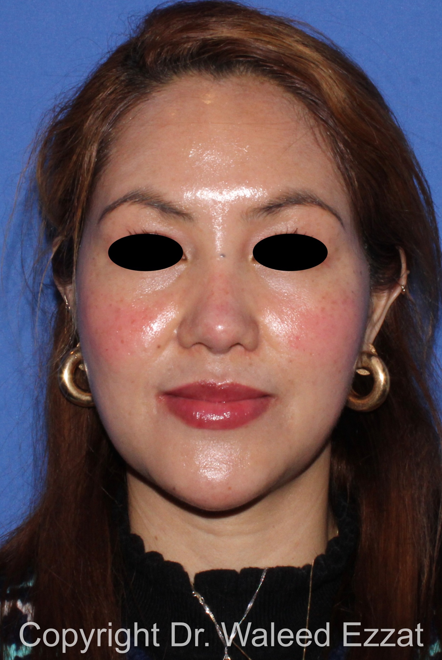 East Asian Rhinoplasty Patient Photo - Case 214 - after view-2