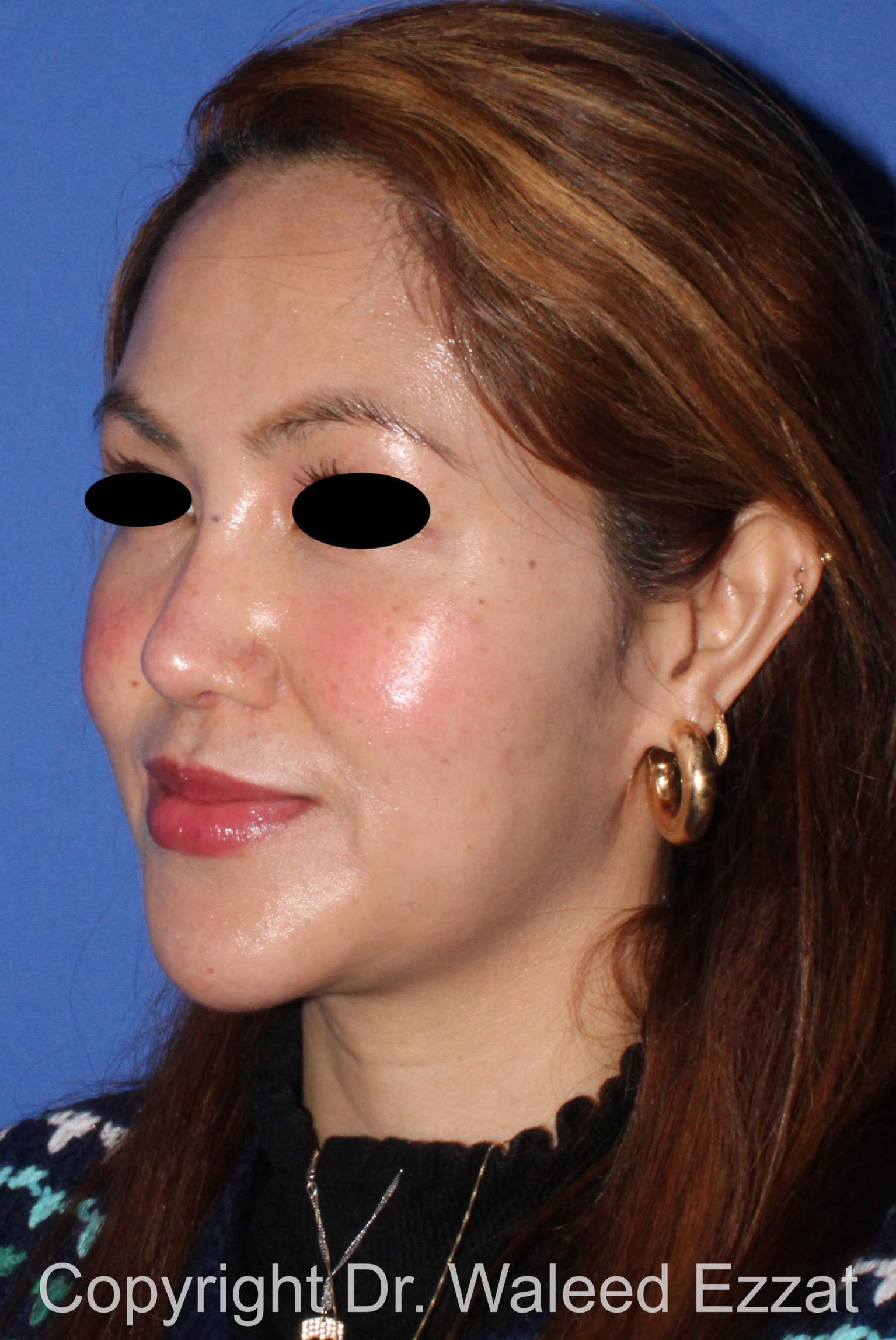 East Asian Rhinoplasty Patient Photo - Case 214 - after view-1