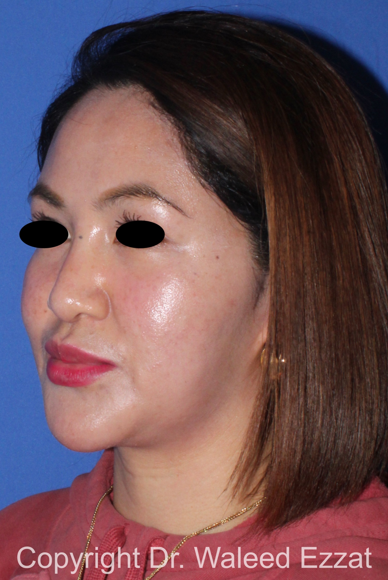 East Asian Rhinoplasty Patient Photo - Case 214 - before view-1