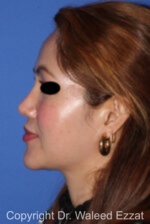 East Asian Rhinoplasty - Case 214 - After