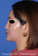 East Asian Rhinoplasty - Case 214 - Before