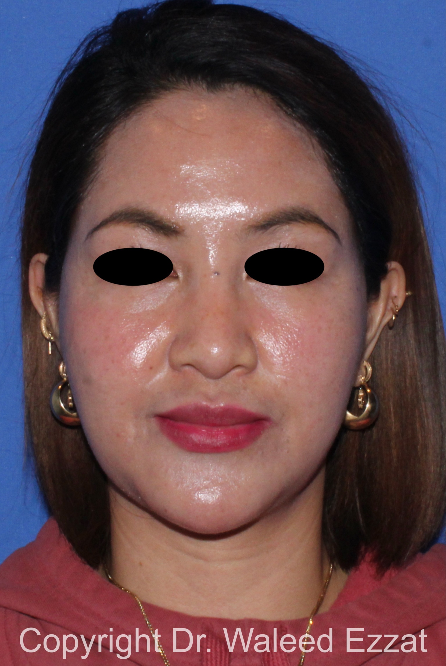 East Asian Rhinoplasty Patient Photo - Case 214 - before view-2