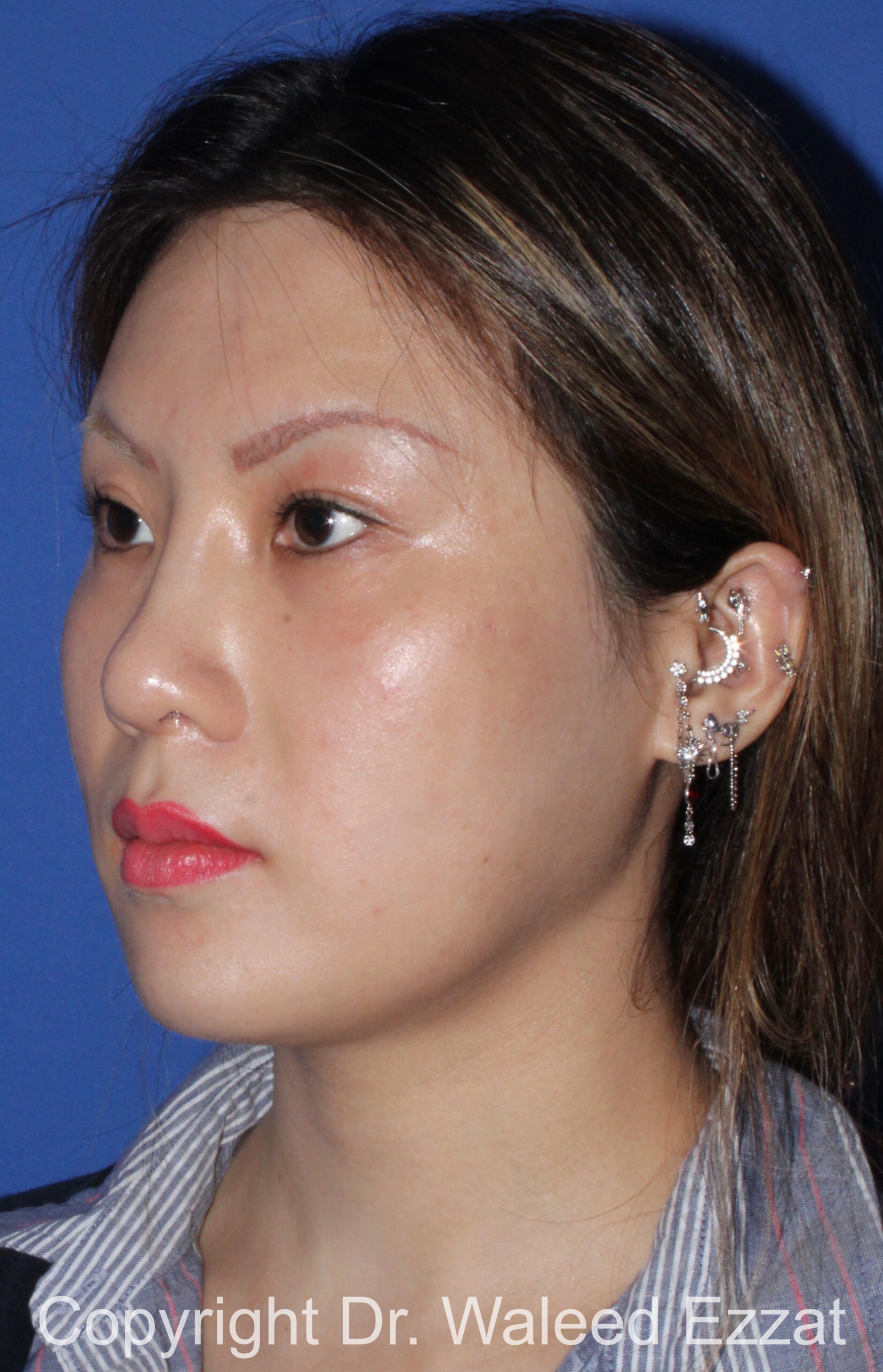East Asian Rhinoplasty Patient Photo - Case 215 - after view-1