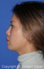 East Asian Rhinoplasty - Case 215 - Before