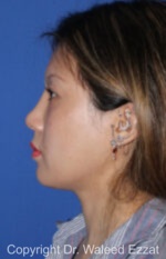 East Asian Rhinoplasty - Case 215 - After