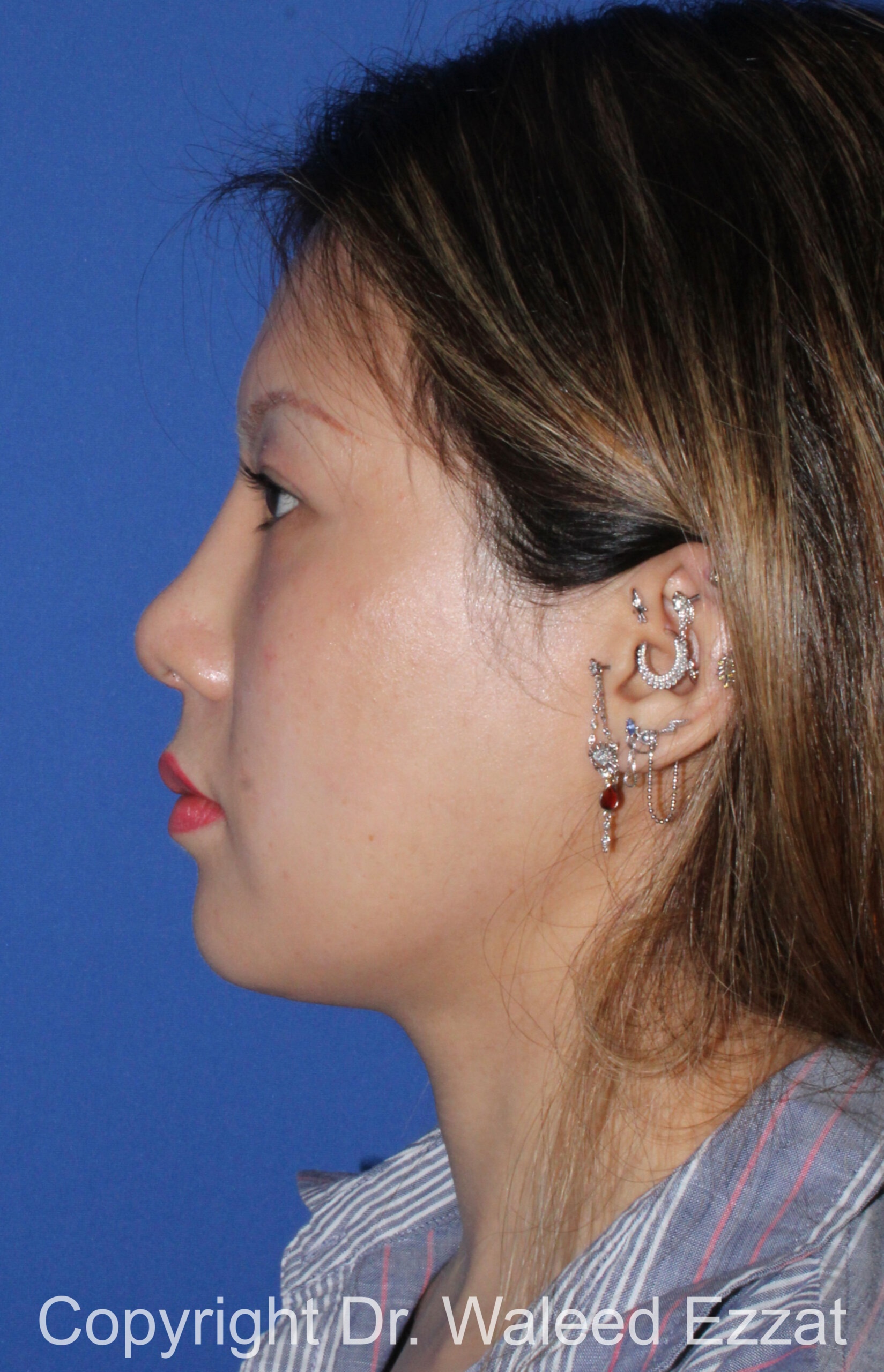 East Asian Rhinoplasty Patient Photo - Case 215 - after view