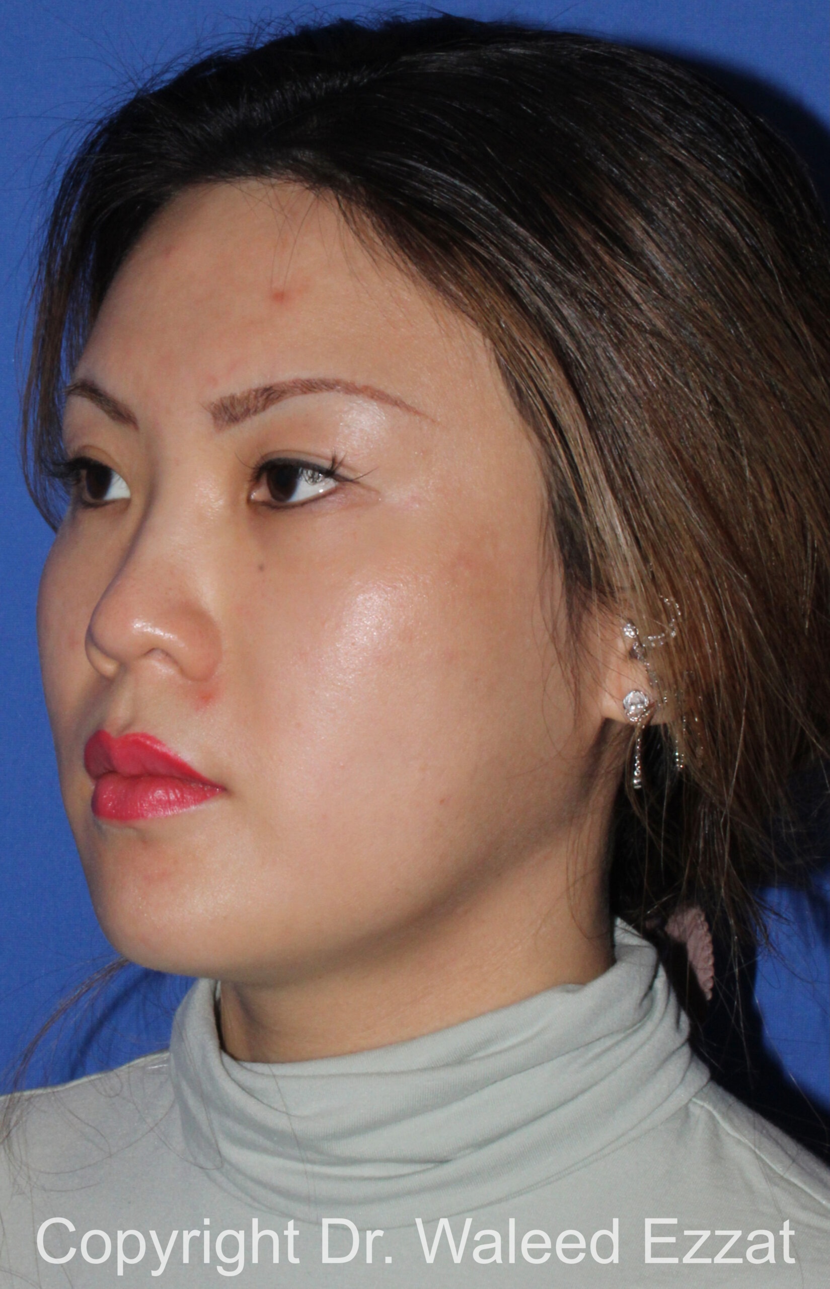East Asian Rhinoplasty Patient Photo - Case 215 - before view-1