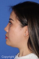 East Asian Rhinoplasty - Case 217 - Before