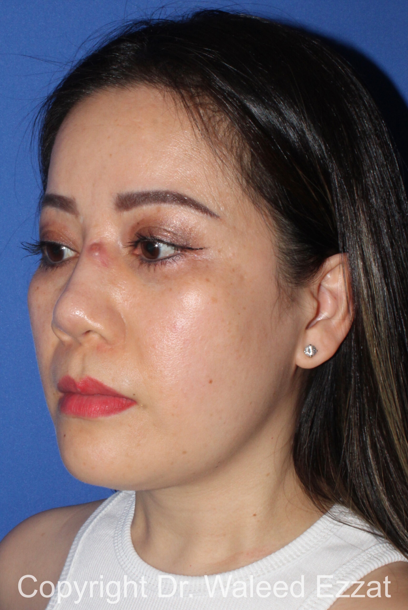 Implant Failure Rhinoplasty Patient Photo - Case 217 - before view-1