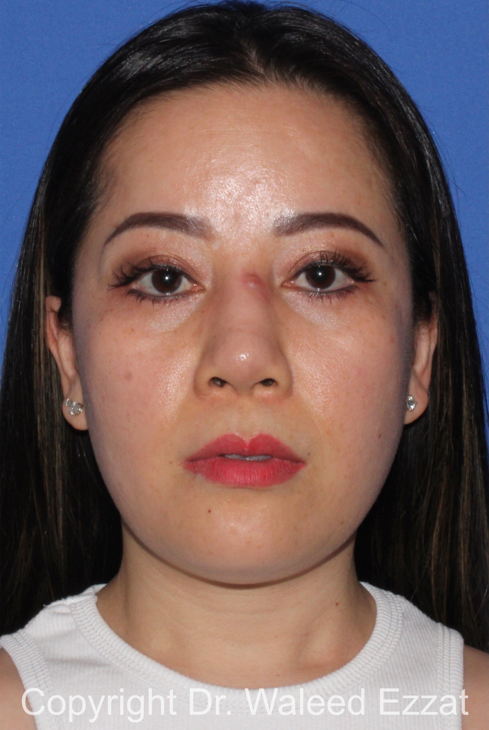 Implant Failure Rhinoplasty Patient Photo - Case 217 - before view-2