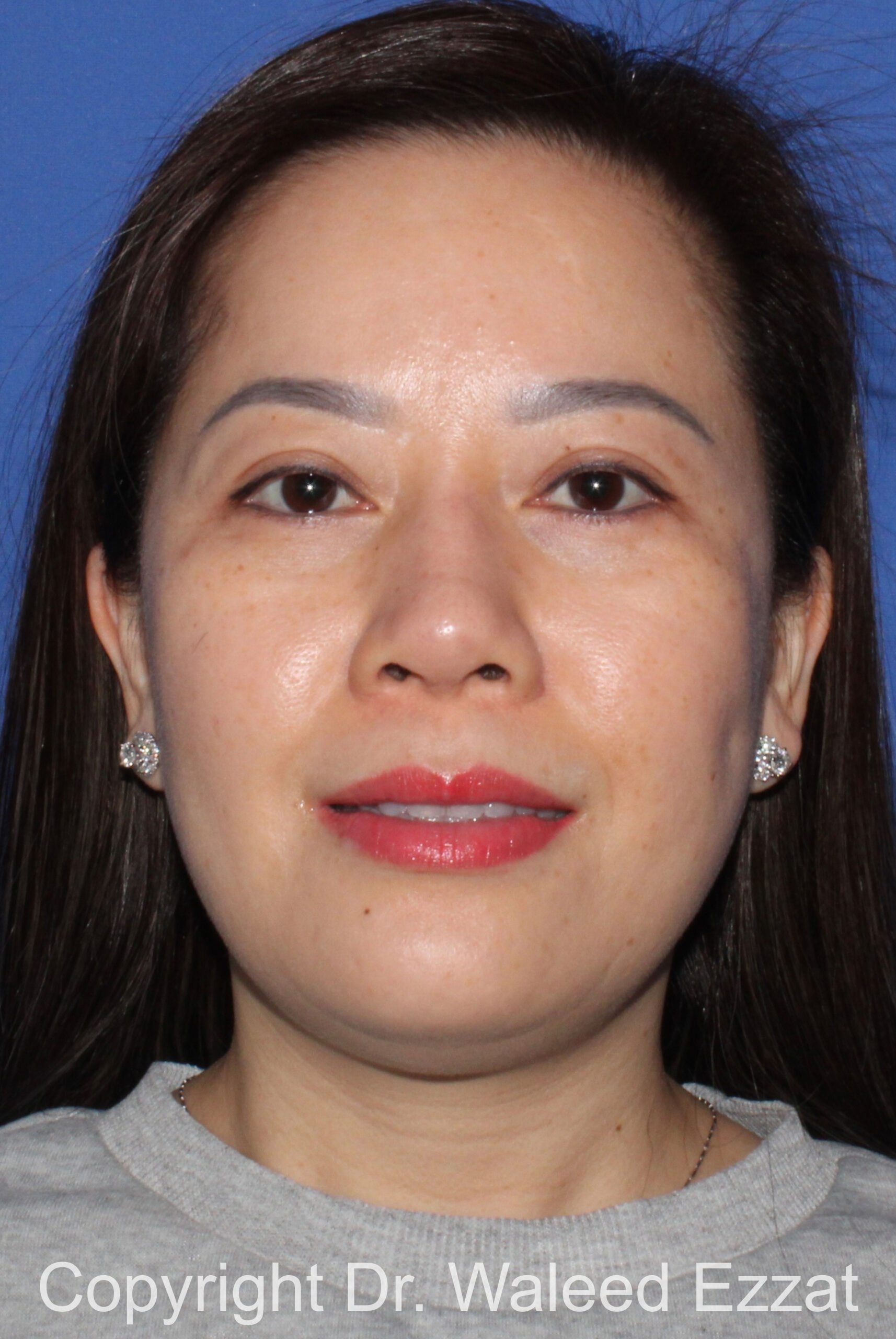 Implant Failure Rhinoplasty Patient Photo - Case 217 - after view-2