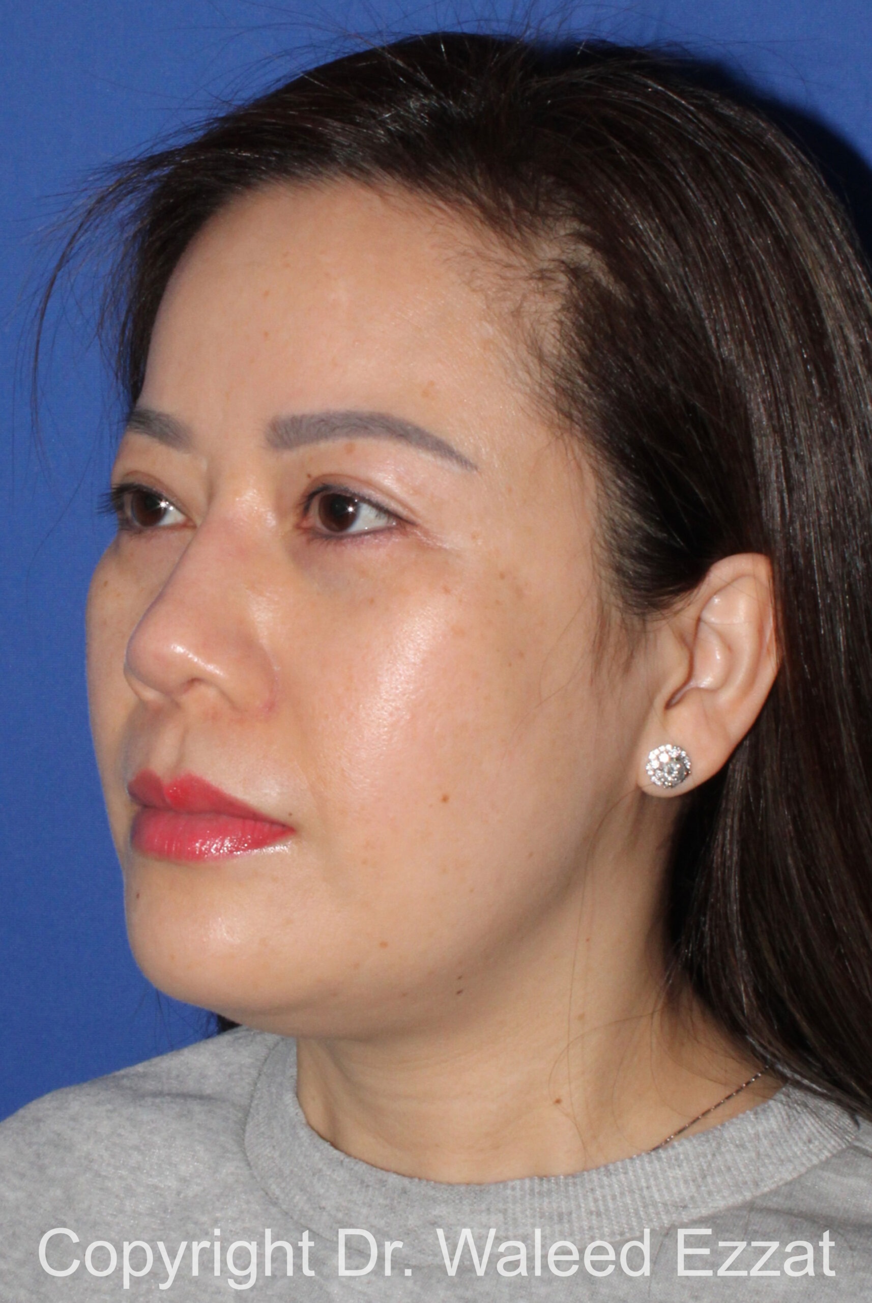 Implant Failure Rhinoplasty Patient Photo - Case 217 - after view-1