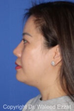 East Asian Rhinoplasty - Case 217 - After