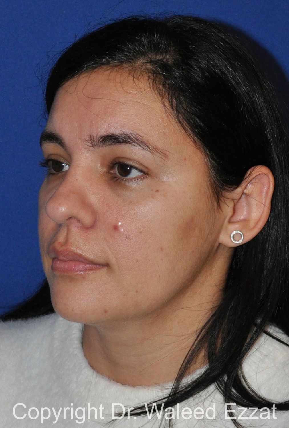 Hispanic/South American Rhinoplasty Patient Photo - Case 289 - after view-1
