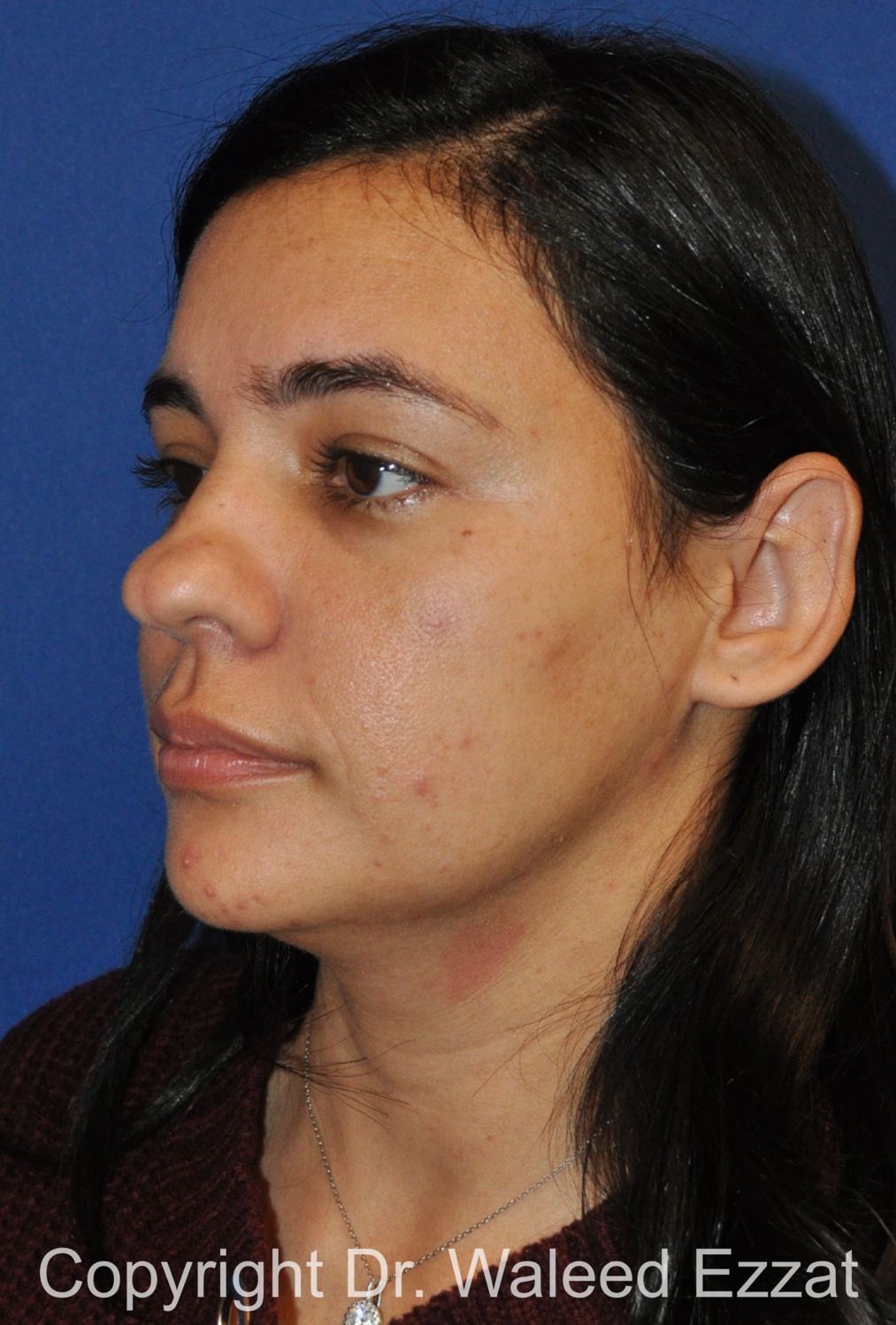 Hispanic/South American Rhinoplasty Patient Photo - Case 289 - before view-1