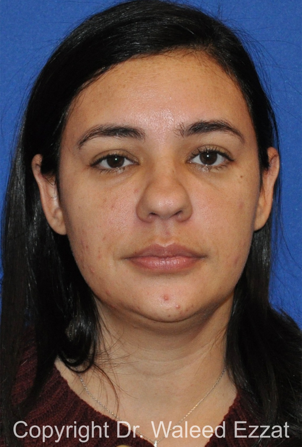 Hispanic/South American Rhinoplasty Patient Photo - Case 289 - before view-2