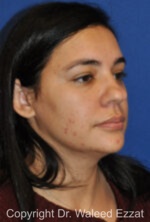 Hispanic/South American Rhinoplasty - Case 289 - Before