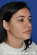 Hispanic/South American Rhinoplasty - Case 289 - After