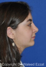 Hispanic/South American Rhinoplasty - Case 295 - After