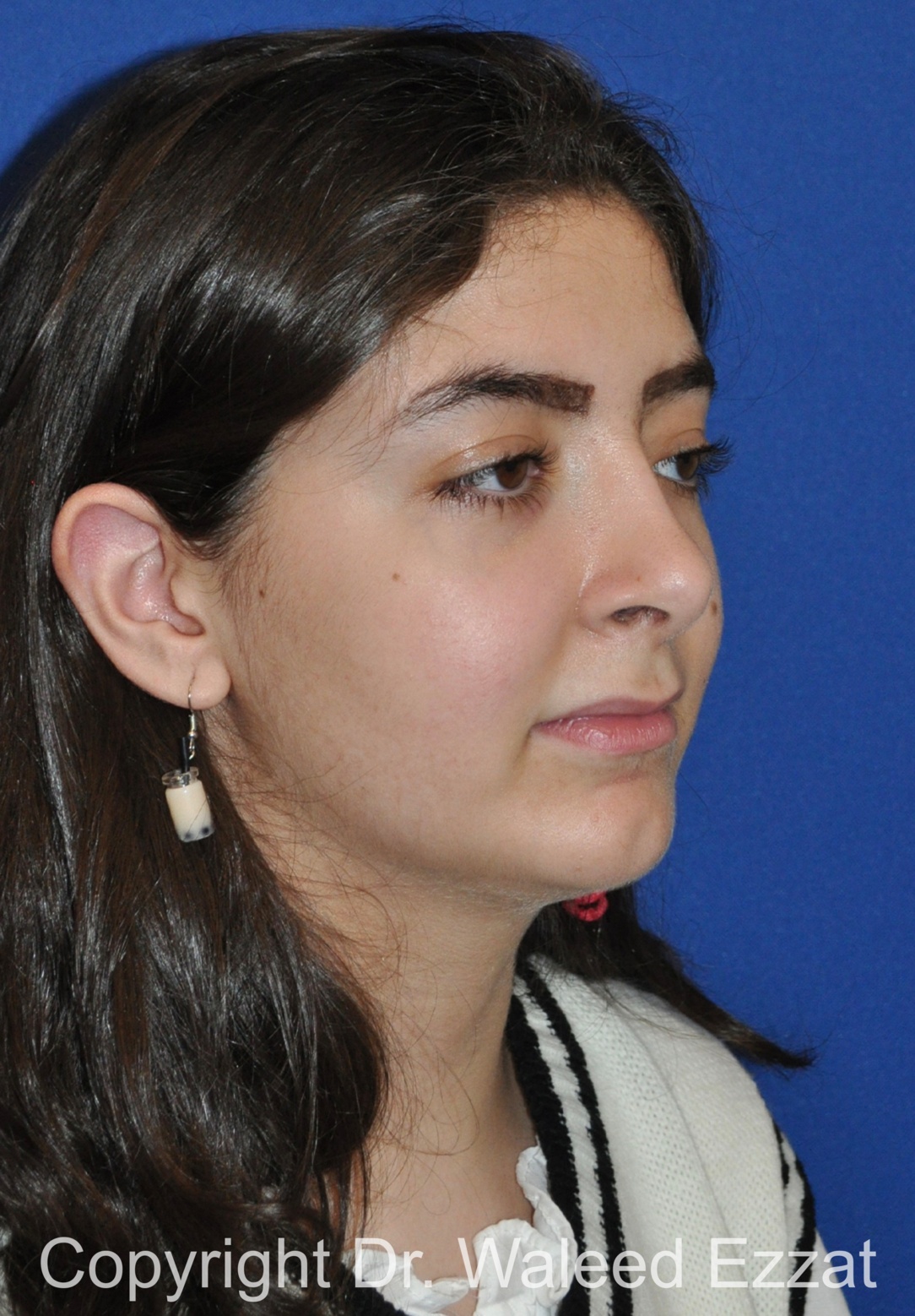 Hispanic/South American Rhinoplasty Patient Photo - Case 295 - after view-1