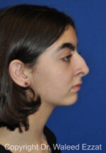 Hispanic/South American Rhinoplasty - Case 295 - Before