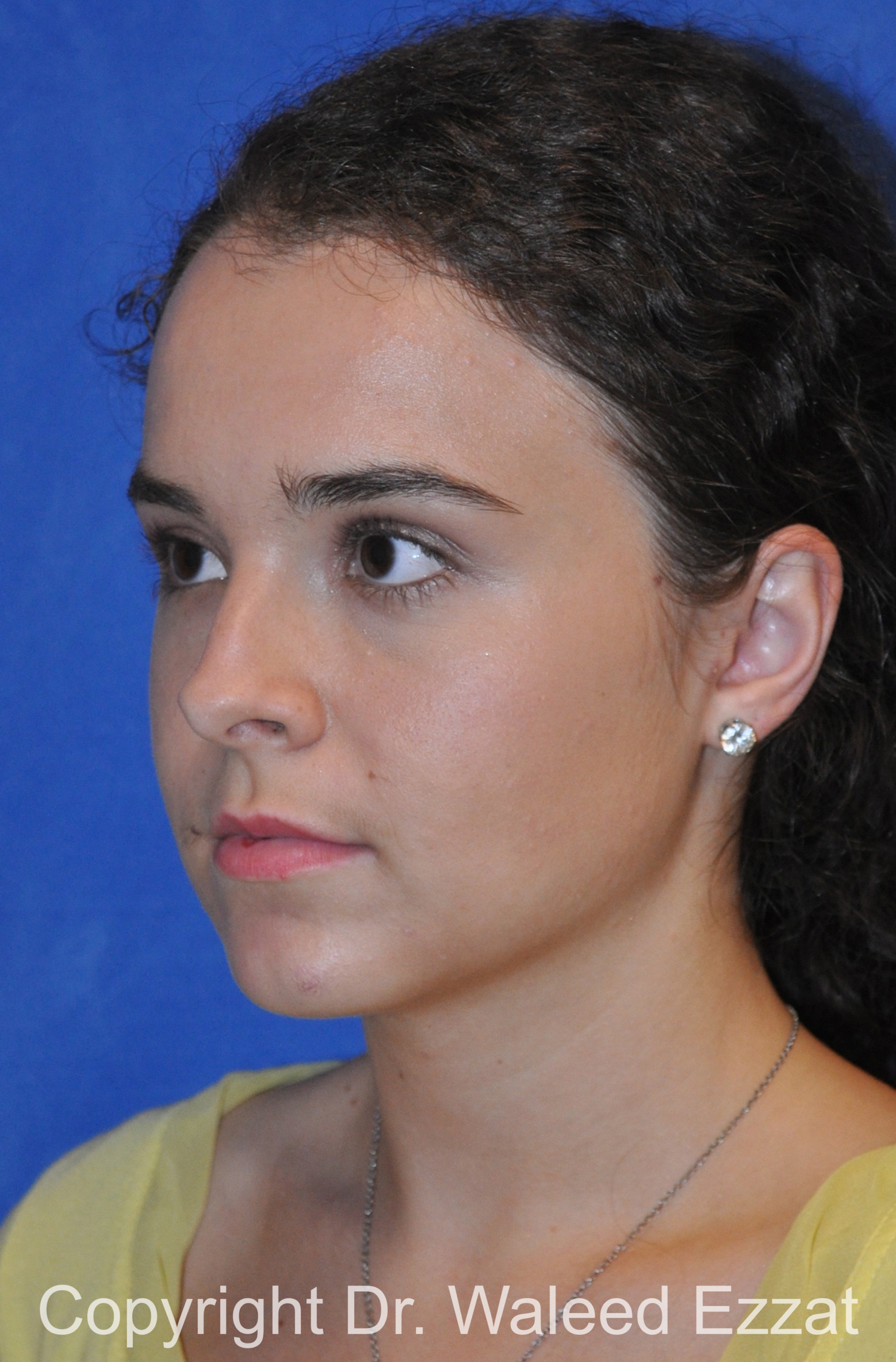 Hispanic/South American Rhinoplasty Patient Photo - Case 296 - before view-1