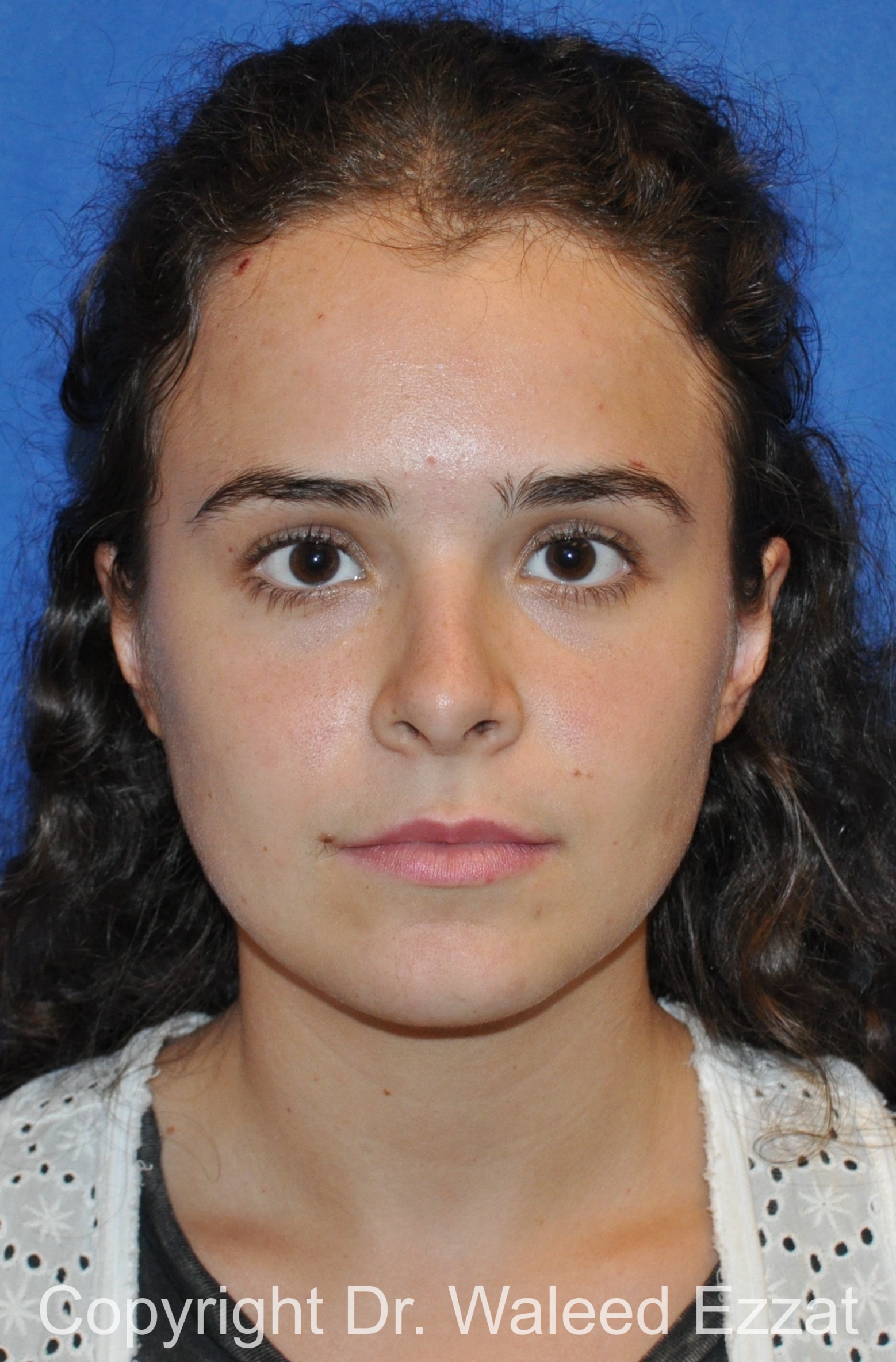 Hispanic/South American Rhinoplasty Patient Photo - Case 296 - after view-2