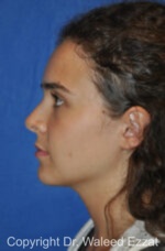 Hispanic/South American Rhinoplasty - Case 296 - After