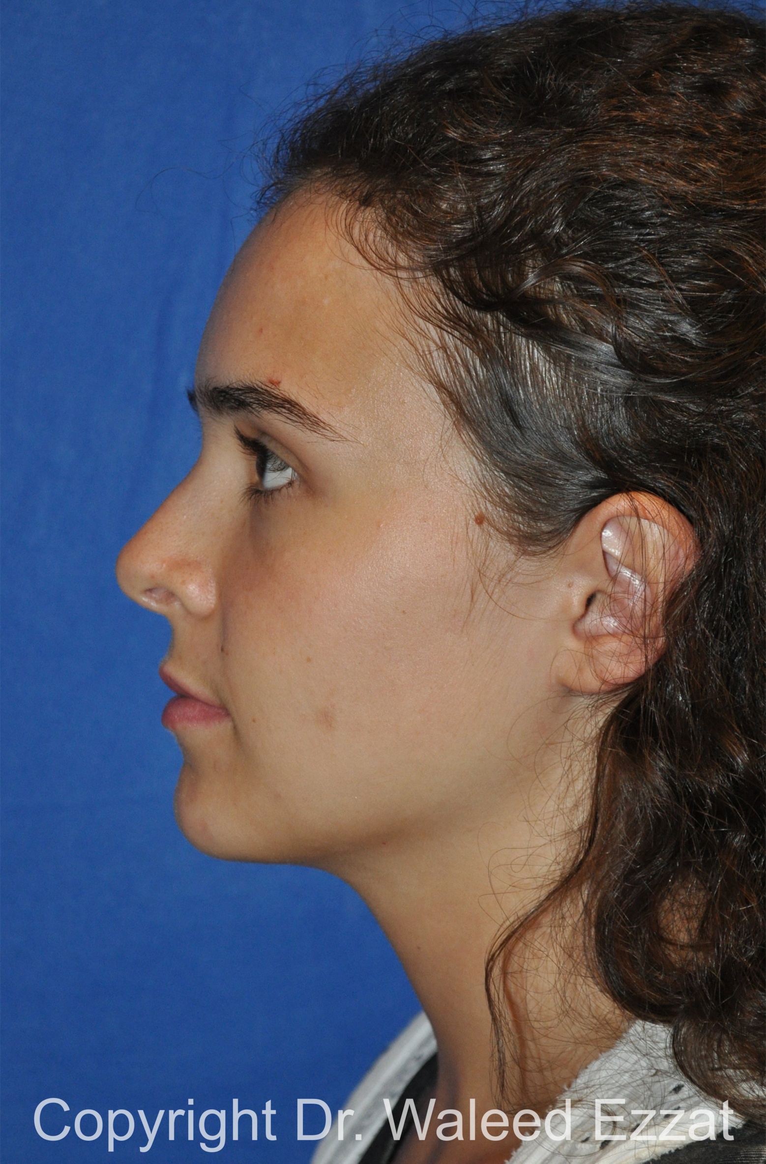 Hispanic/South American Rhinoplasty Patient Photo - Case 296 - after view