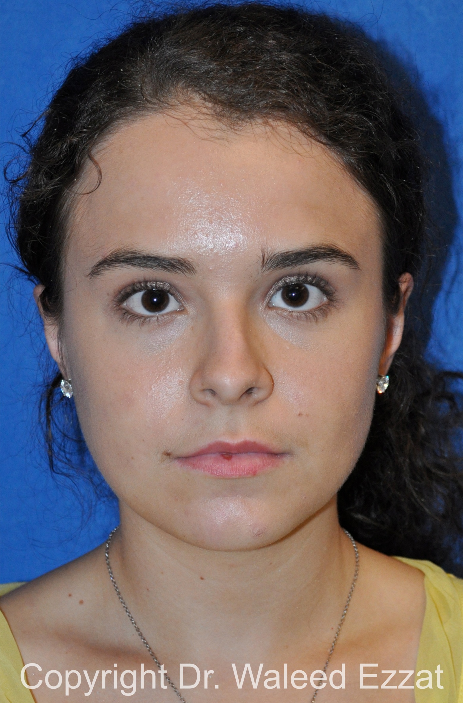 Hispanic/South American Rhinoplasty Patient Photo - Case 296 - before view-2