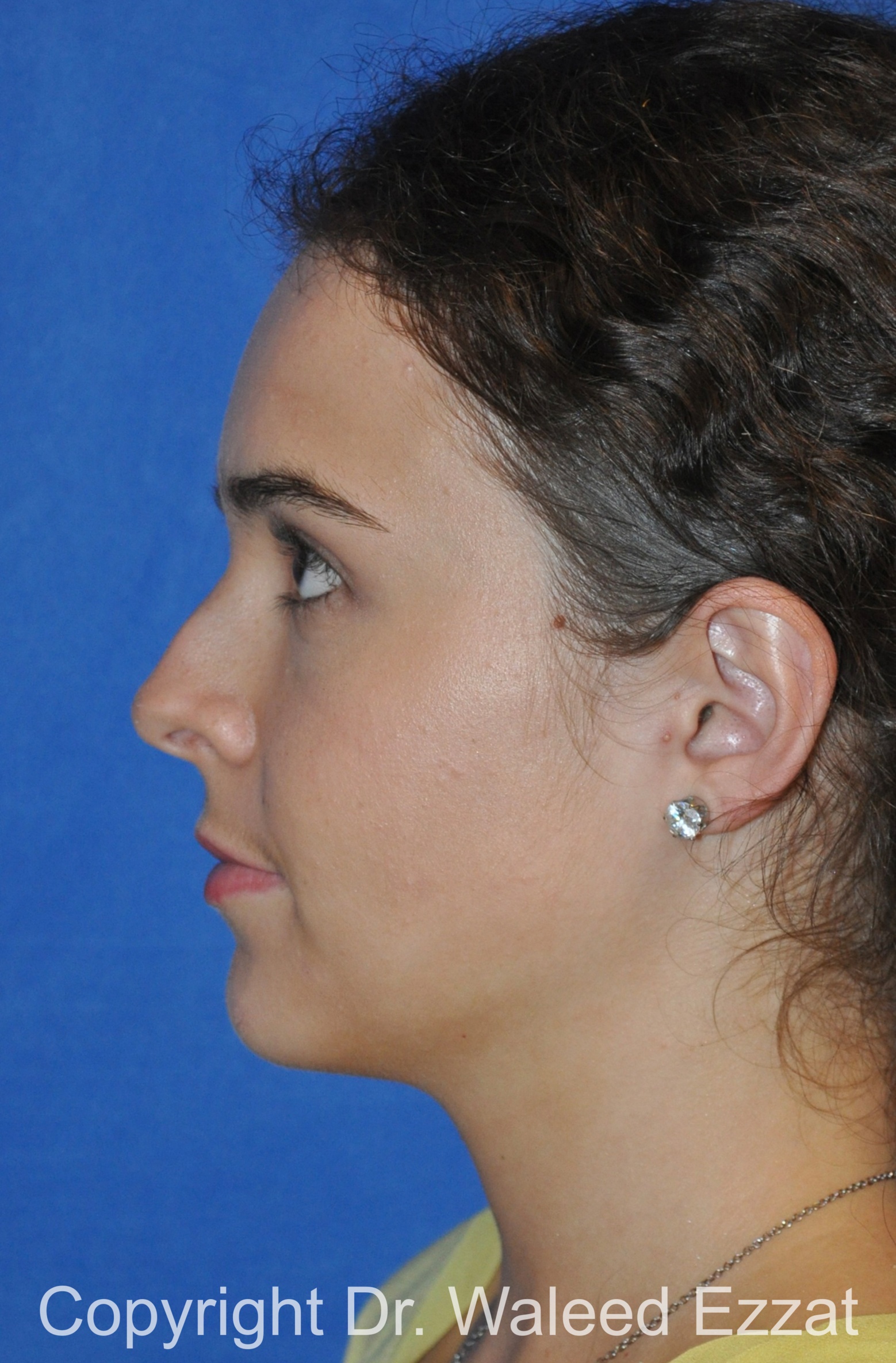 Hispanic/South American Rhinoplasty Patient Photo - Case 296 - before view-