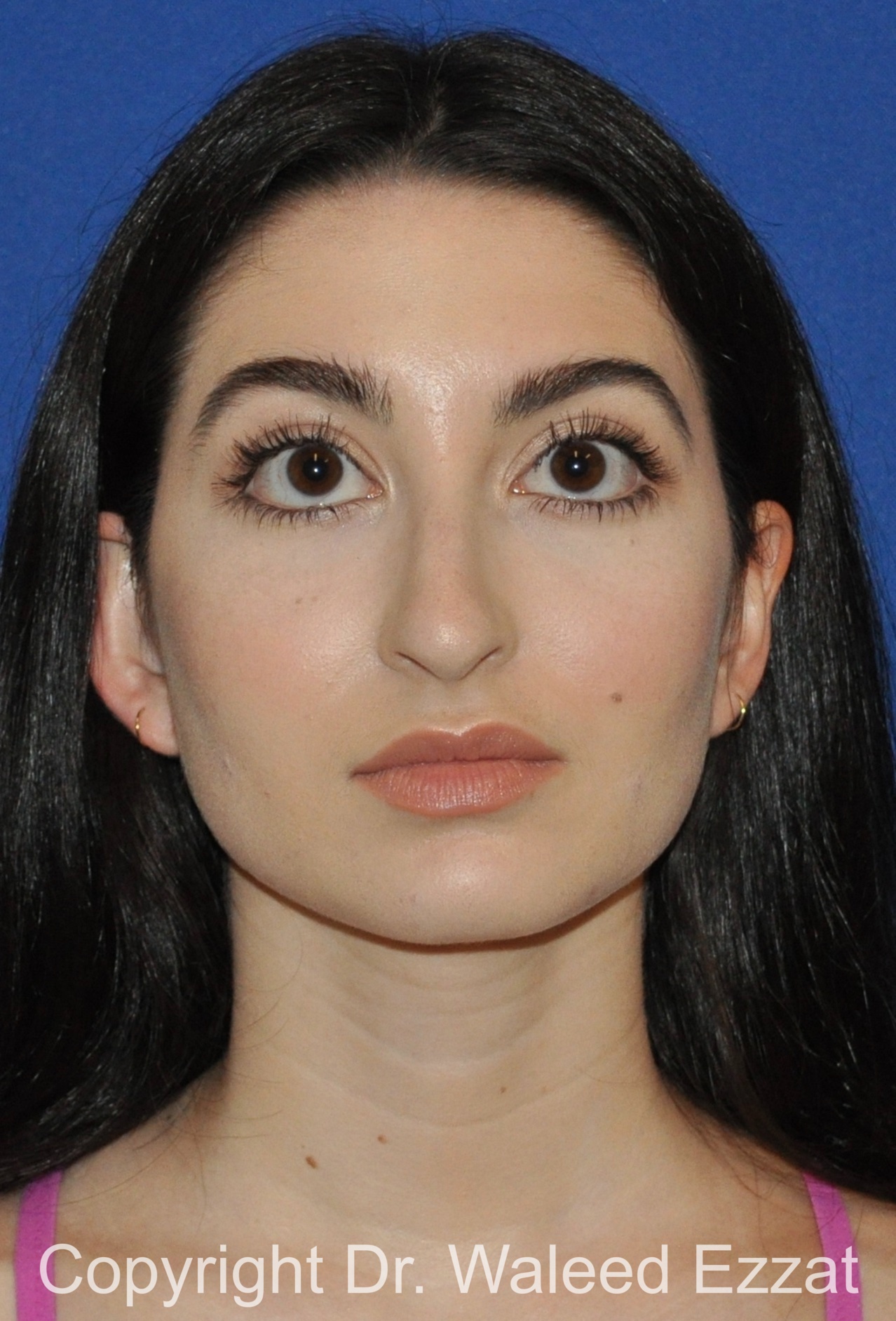 Hispanic/South American Rhinoplasty Patient Photo - Case 297 - before view-2