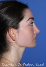 Hispanic/South American Rhinoplasty - Case 297 - After