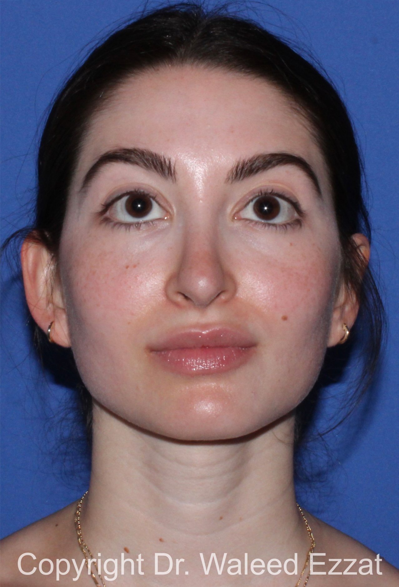 Hispanic/South American Rhinoplasty Patient Photo - Case 297 - after view-2