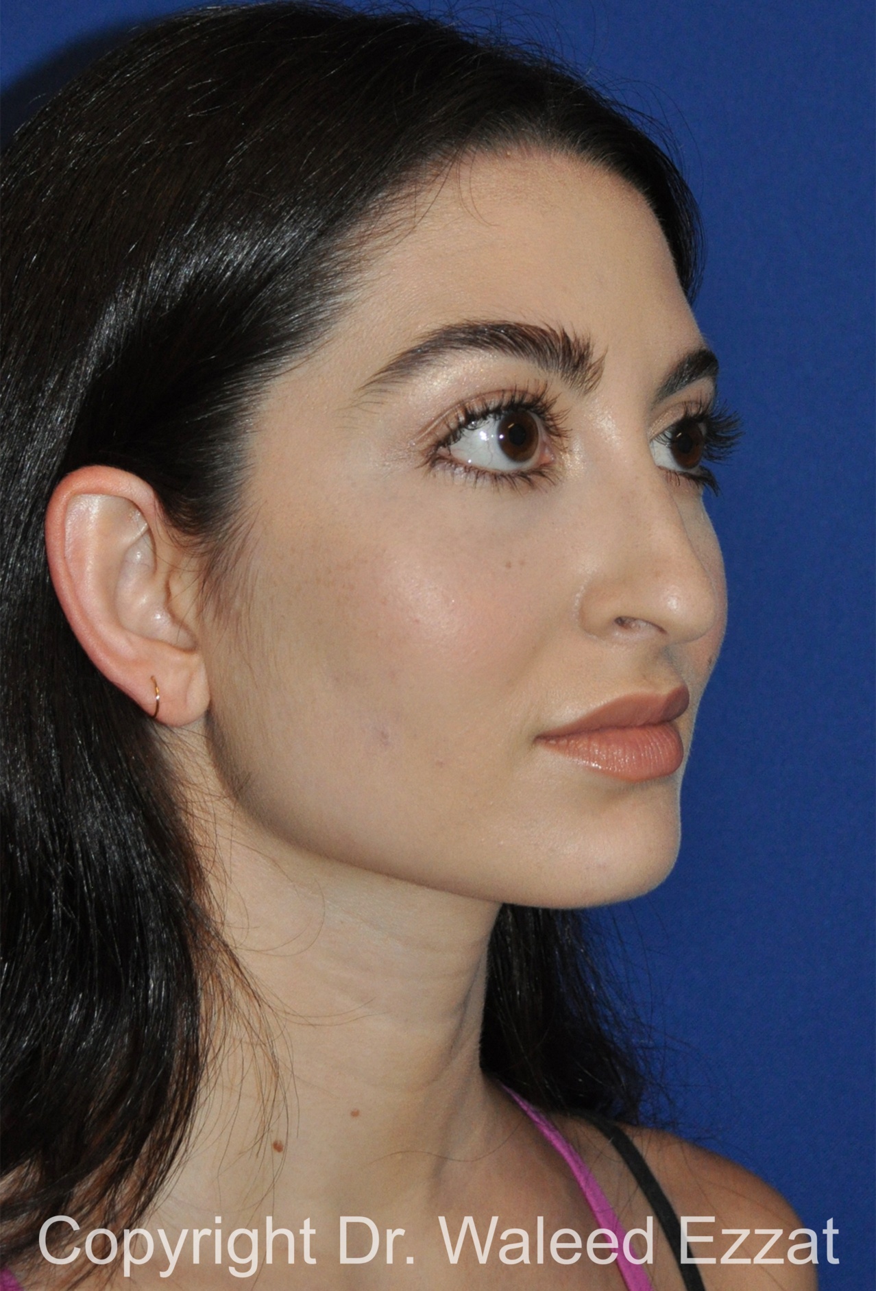 Hispanic/South American Rhinoplasty Patient Photo - Case 297 - before view-1