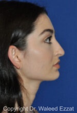 Hispanic/South American Rhinoplasty - Case 297 - Before